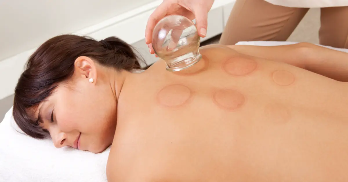 Therapist lifting a glass cup from a woman's back, leaving faint round cupping marks